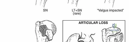 Illustration of humerus fractures proximal - Dr. Mohammed Hutaif