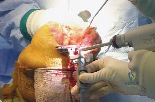 صورة طبية: استبدال مفصل الركبة الكلي المثبت خلفياً (PS TKA): دليل شامل لنجاح الجراحة والتعافي