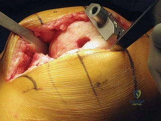 تقوس الساقين بسبب الخشونة