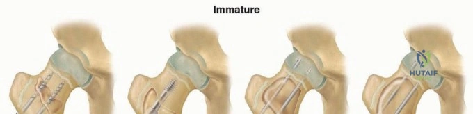 Operative Management of Congenital Foot and Toe Anomalies