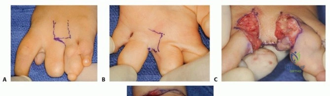 Principles of Spinal Arthrodesis: Biomechanics, Bone Grafting, and Surgical Techniques