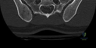 Total Hip Arthroplasty: Principles, Biomechanics, and Surgical Techniques