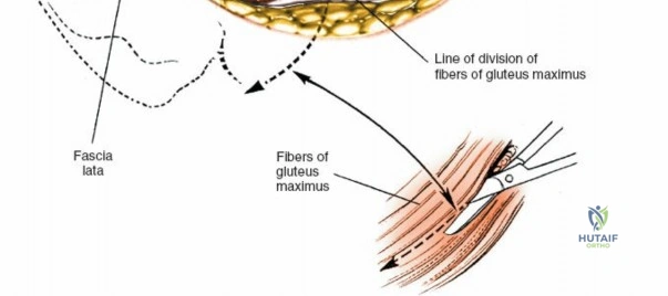 Operative Management of Biceps Brachii and Posterior Tibial Tendon Displacement