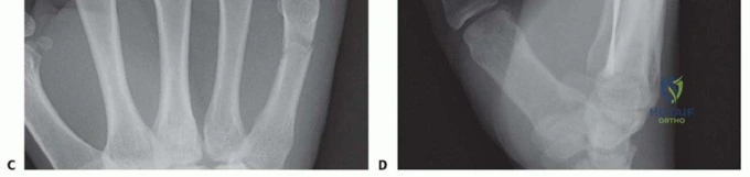 Management of Chronic and Unreduced Dislocations: A Comprehensive Surgical Masterclass
