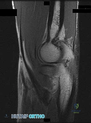 Surgical Management of the Upper Extremity in Cerebral Palsy