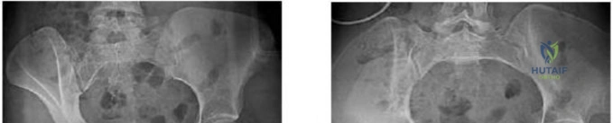 Operative Management of the Arthritic Hand: Rheumatoid and Osteoarthritic Reconstructions