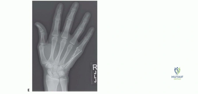 Comprehensive Surgical Management of Lesser Toe Deformities and Forefoot Pathologies