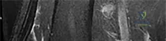 Reoperation and Tissue Monitoring in Microvascular Surgery