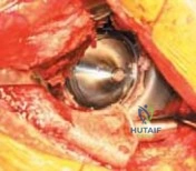 Illustration of hip arthroplasty with acetabular - Dr. Mohammed Hutaif