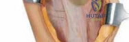 Illustration of exposure tibial tubercle osteotomy - Dr. Mohammed Hutaif