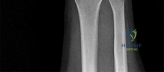 Mastering Rotator Cuff Repair: Pathophysiology, Indications, and Surgical Techniques