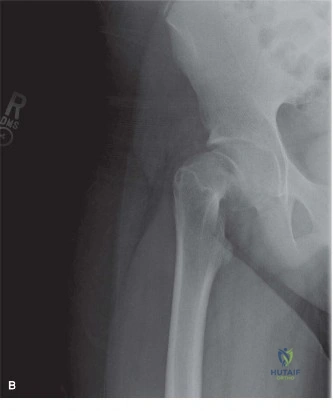 صورة توضيحية لـ الدليل الشامل لانزلاق رأس الفخذ الأعلى (SCFE): الأسباب، التشخيص، والعلاج على يد الأستاذ الدكتور محمد هطيف في صنعاء