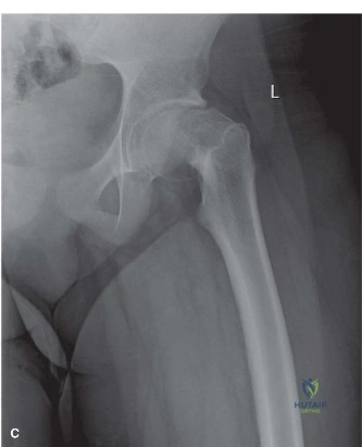 Illustration of engaged in the epiphysis - Dr. Mohammed Hutaif