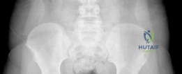 صورة توضيحية لـ علاج انزلاق رأس الفخذ غير المستقر (SCFE): إعادة التوجيه تحت الرأس بسديلة الشبكية الممتدة مع الأستاذ الدكتور محمد هطيف في صنعاء