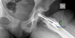Illustration of extended retinacular flap - Dr. Mohammed Hutaif