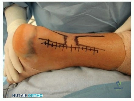 Clinical Presentation of Achilles Rupture