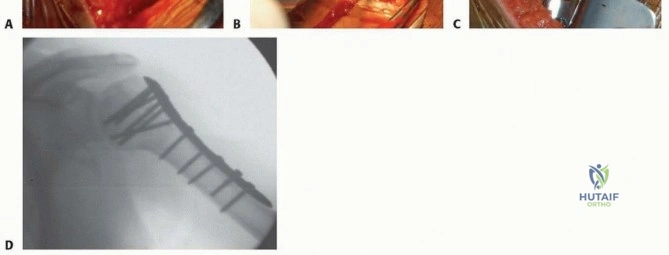 CT Scan Showing Displacement