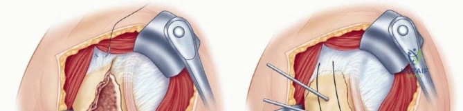 Deltoid Split Approach