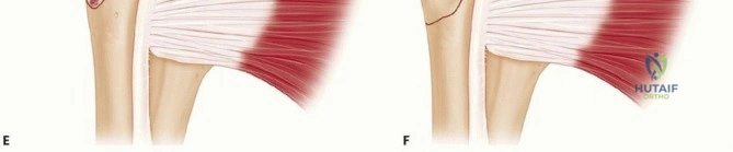 Displaced Fracture Imaging