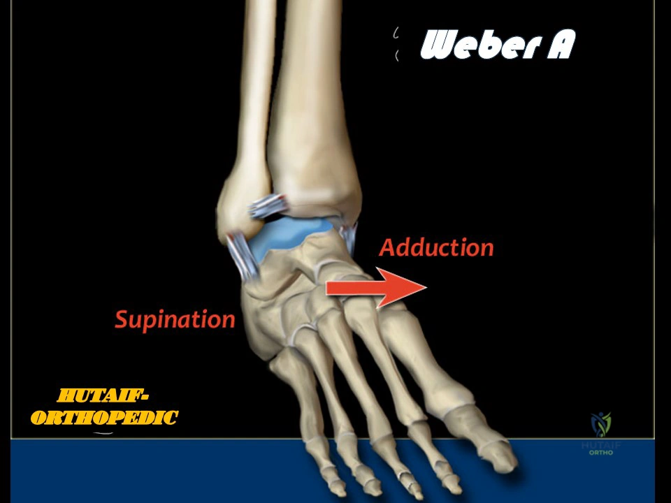 Illustration 1 for Ankle Injuries Weber A