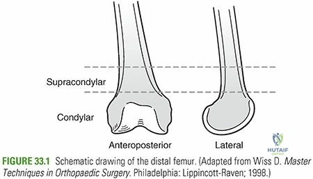 Illustration 1 for Decoding Distal Femur Fractures: Anatomy, Causes & Management