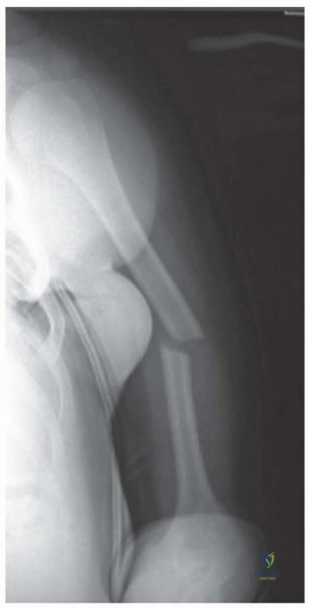 Illustration 1 for Enhance Recovery: Humeral Plate Fixation for Brachialis & Brachioradialis