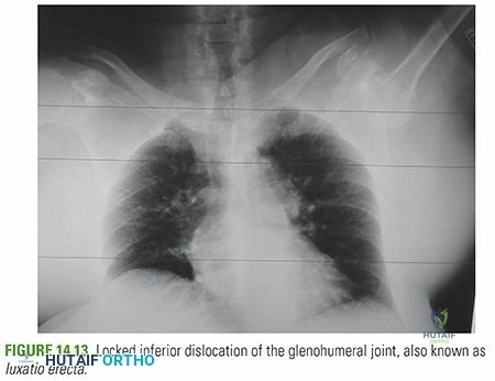 Illustration 1 for Inferior Glenohumeral Dislocation: Symptoms, Diagnosis & Treatment