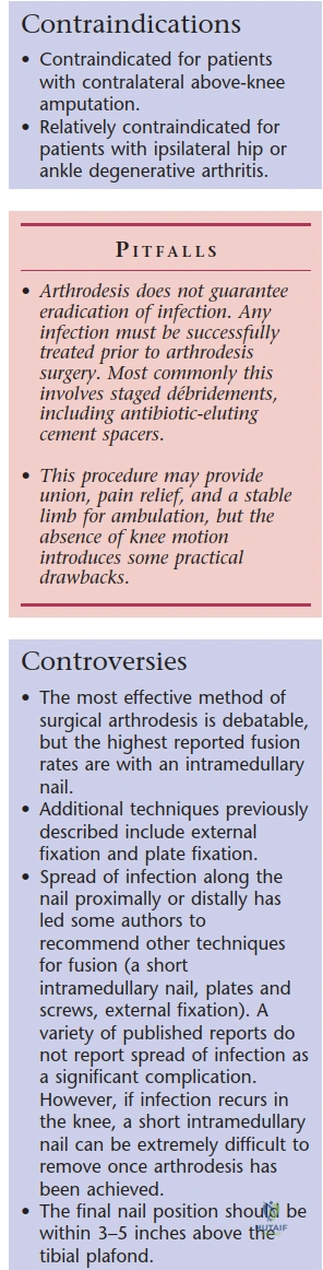 Illustration 1 for Intramedullary Arthrodesis: Solving Failed Total Knee Arthroplasty