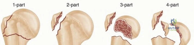 Illustration 1 for Mastering O.R.I.F. for Displaced Proximal Humeral Fractures