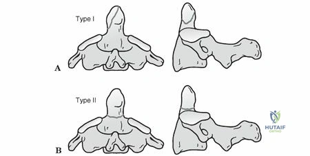 Illustration 1 for Odontoid Process Dens Fractures: Understanding Risks & Recovery