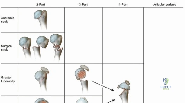 Illustration 1 for Optimize Twopart Surgical Neck Fracture Fixation with IM Nailing
