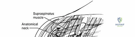 Illustration 1 for Proximal Humerus Fractures: Essential Guide to Anatomy & Recovery