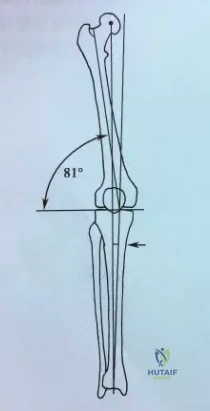 Illustration 1 for 股骨远端骨折挑战重重?c ct mridoppler 精准评估,助您掌握关键固定技巧,确保手术成功与膝关节功能!