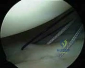 Illustration 10 for Arthroscopic Treatment of Multidirectional Instability: A Test Positive Result Guide