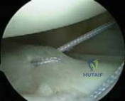 Illustration 11 for Arthroscopic Treatment of Multidirectional Instability: A Test Positive Result Guide