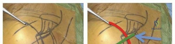 Illustration 11 for Optimize Twopart Surgical Neck Fracture Fixation with IM Nailing
