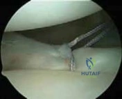 Illustration 12 for Arthroscopic Treatment of Multidirectional Instability: A Test Positive Result Guide