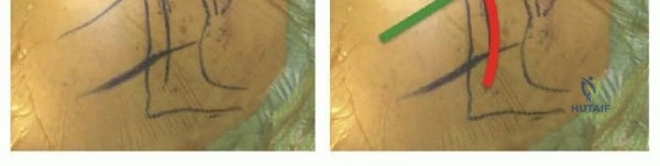 Illustration 12 for Optimize Twopart Surgical Neck Fracture Fixation with IM Nailing