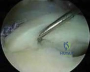 Illustration 13 for Arthroscopic Treatment of Multidirectional Instability: A Test Positive Result Guide