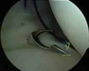 Illustration 17 for Arthroscopic Treatment of Multidirectional Instability: A Test Positive Result Guide