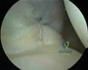 Illustration 18 for Arthroscopic Treatment of Multidirectional Instability: A Test Positive Result Guide
