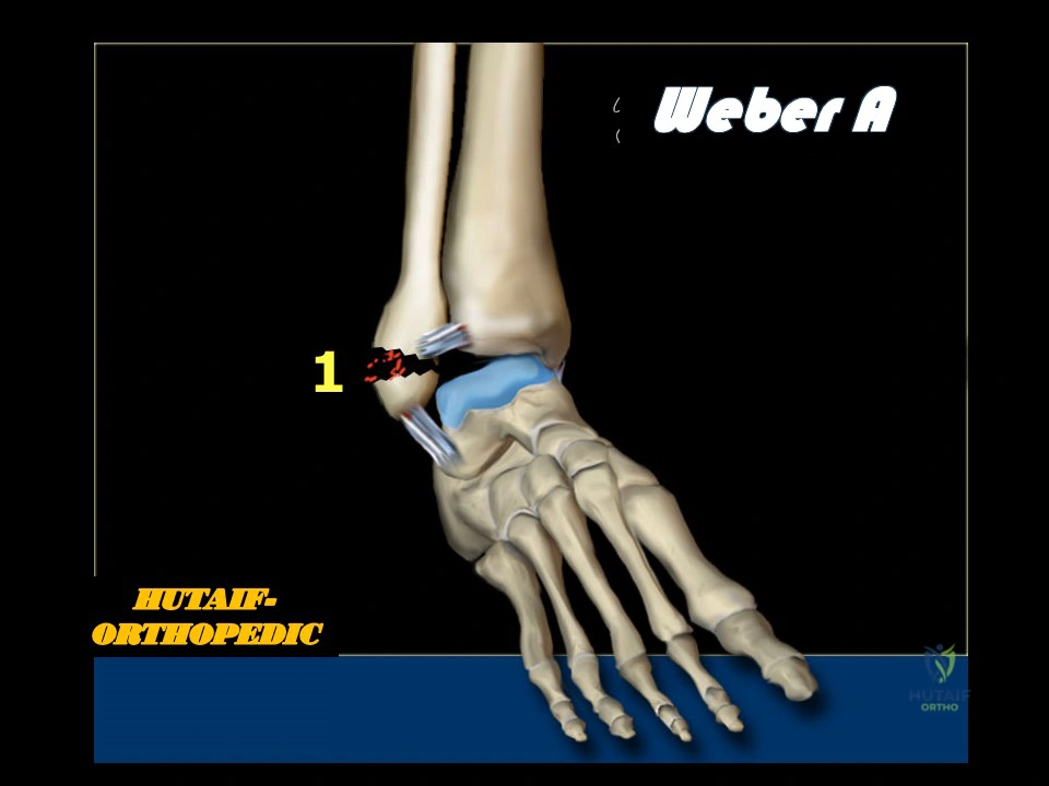 Illustration 2 for Ankle Injuries Weber A