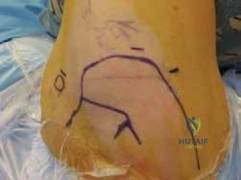 Illustration 2 for Arthroscopic Treatment of Multidirectional Instability: A Test Positive Result Guide