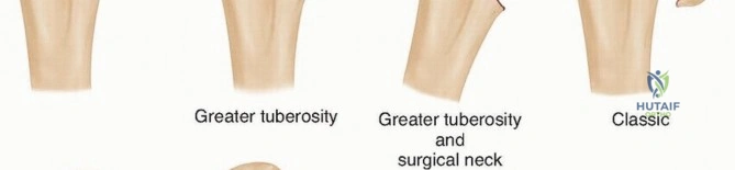 Illustration 2 for Mastering O.R.I.F. for Displaced Proximal Humeral Fractures