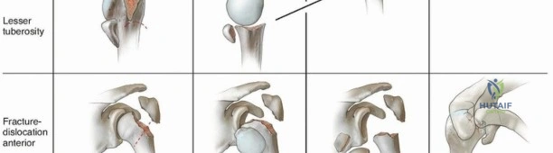 Illustration 2 for Optimize Twopart Surgical Neck Fracture Fixation with IM Nailing