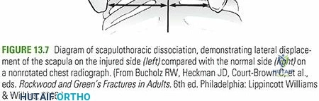 Illustration 2 for Scapulothoracic Dissociation: A Guide to This Rare Scapulothoracic Injury