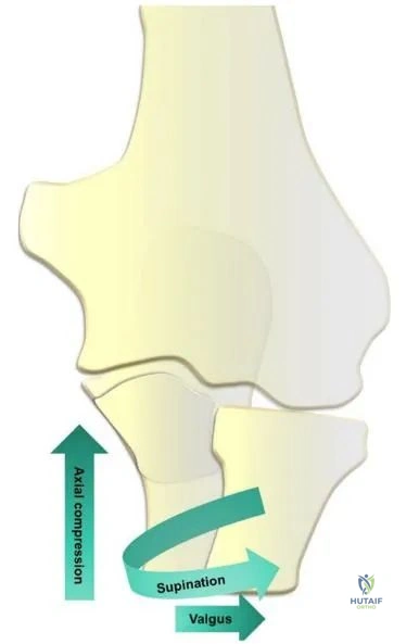 Illustration 2 for Triad of the Elbow: Master Diagnosis & Treatment with Our Guide
