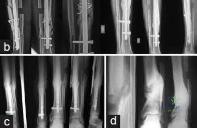 Illustration 221 for OrthoCash: Trauma MCQs & Cases for a yearold woman