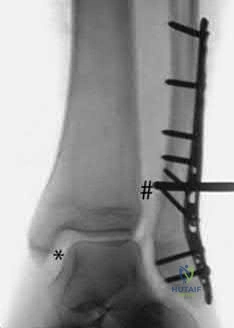 Illustration 225 for OrthoCash: Trauma MCQs & Cases for a yearold woman