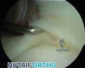 Illustration 3 for Arthroscopic Treatment of Multidirectional Instability: A Test Positive Result Guide
